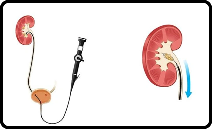 Medical treatment for urinary stones